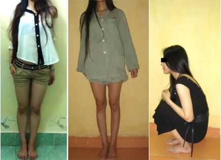 Cô gái Hà Nội cao 1m38 thực hiện kéo dài chân