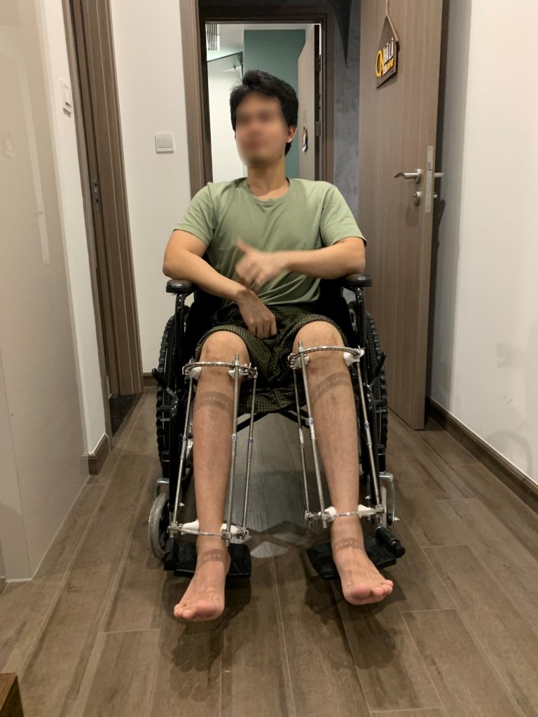 A foreigner came to Vietnam for limb lengthening