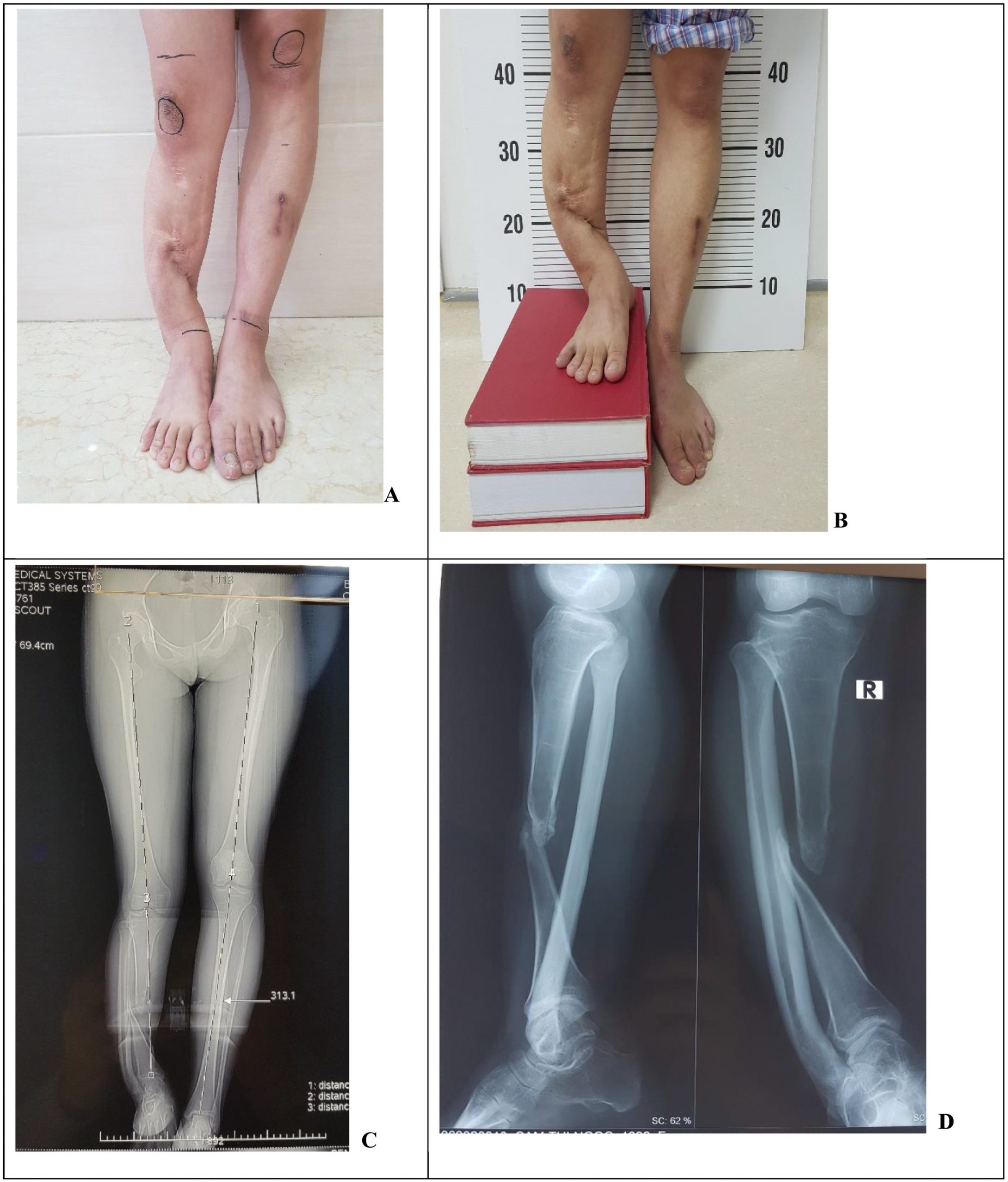 Fibula lengthening then centralization for the treatment of pseudoarthrosis at the middle third of tibia with large leg-length discrepancy – A case report