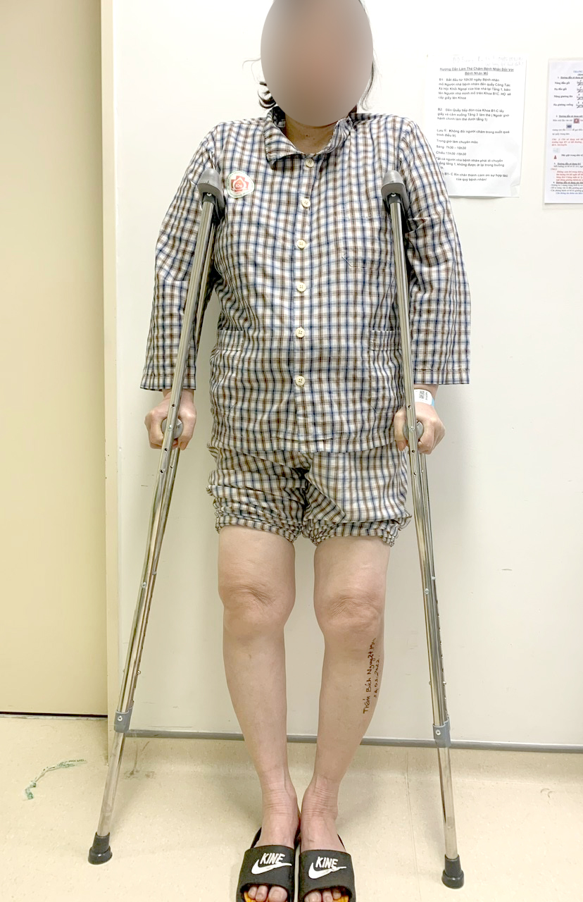 Nguy cơ thay khớp gối ở người bị chân vòng kiềng không được điều trị sớm
